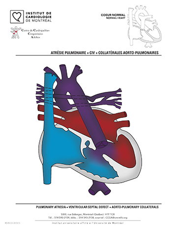 Artésie pulmonaire + CIV + Collatérales aorto-pulmonaires