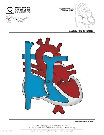 Coarctation de l'aorte