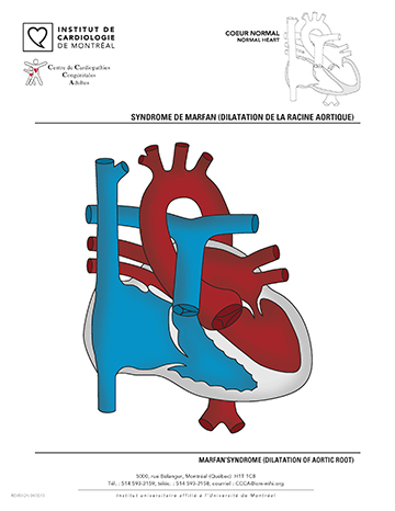 Syndrome de Marfan (dilatation de la racine aortique)